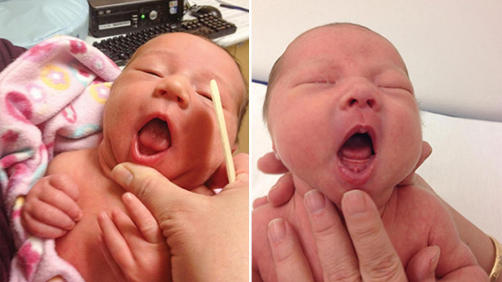 PHOTO: A new report from the American Academy of Pedatrics suggests tongue-tie or ankyloglossia may be overly diagnosed in babies and children.