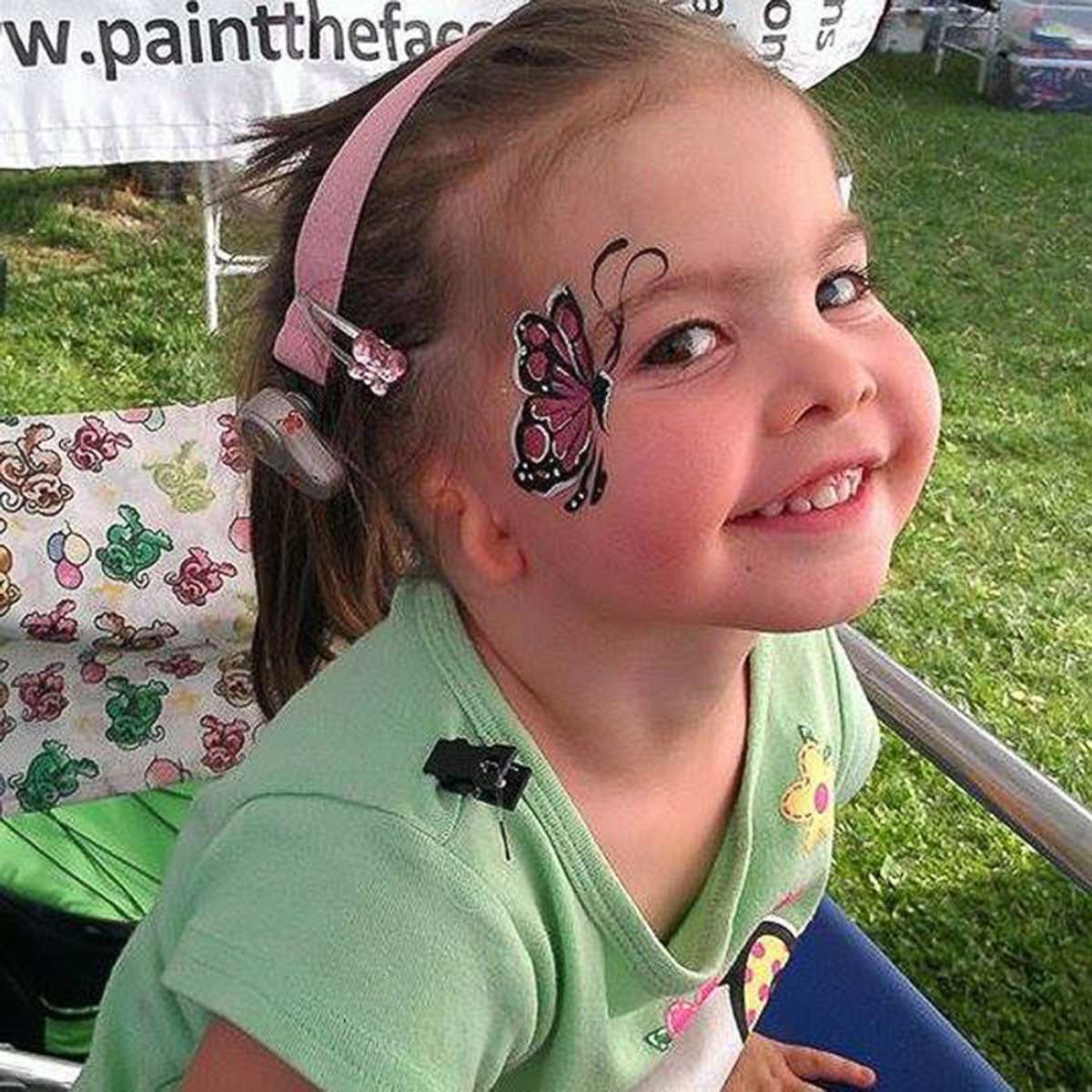 PHOTO: Ally Tumblin, now 9, was born with the absence of her right ear and ear canal.