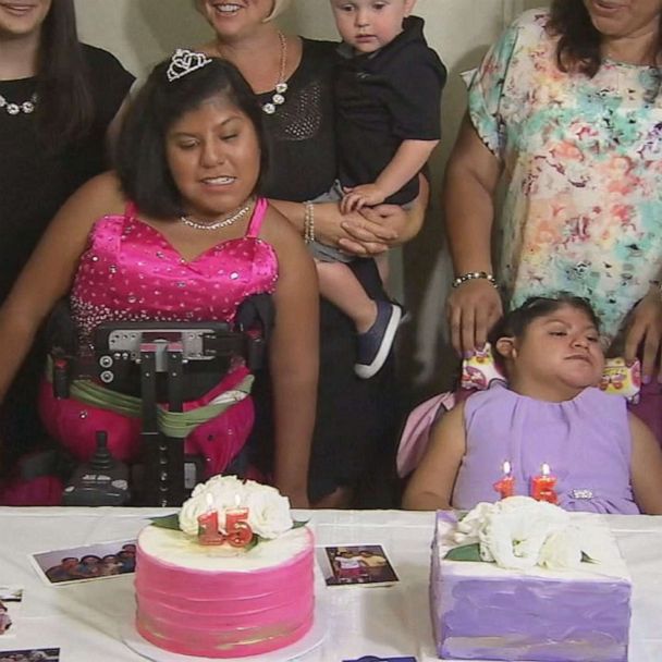 Formerly conjoined twins celebrate 21st birthday