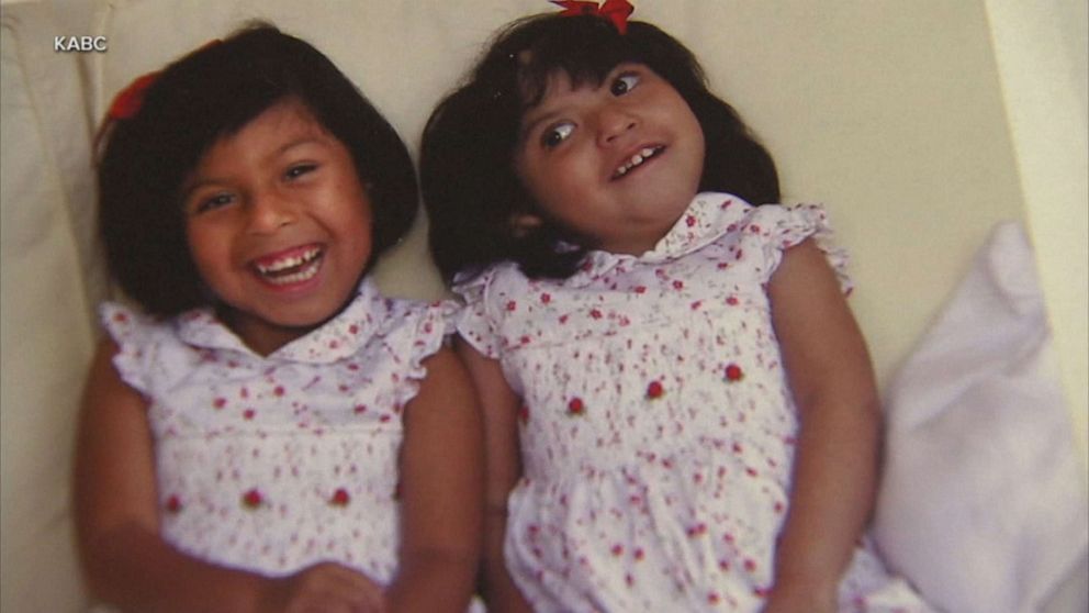 PHOTO: Formerly conjoined twins Josie Hull and Teresa Cajas.