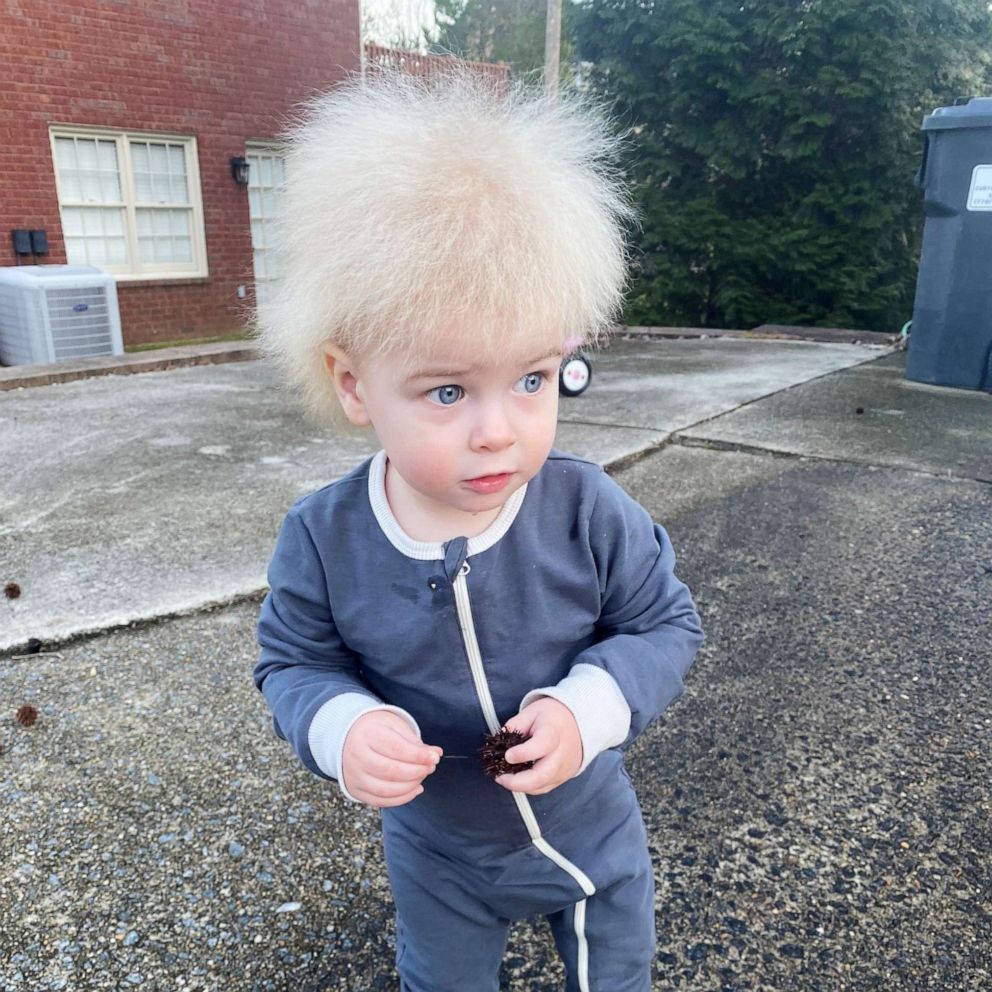 VIDEO: One-year-old boy has extremely rare ‘uncombable hair syndrome’