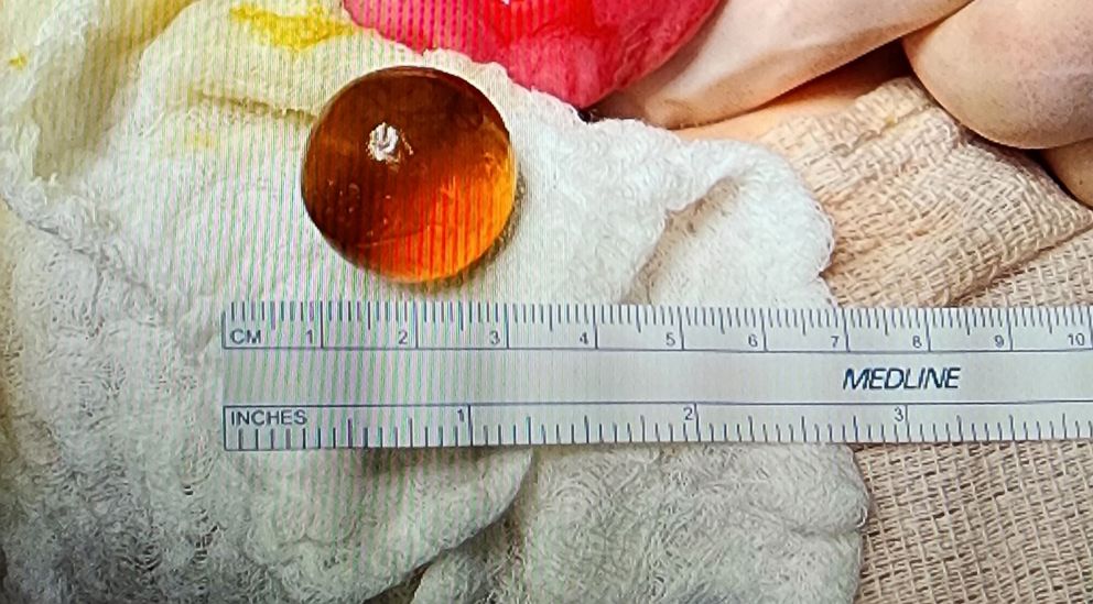 PHOTO: Hannah Rief shared a photo of the water bead removed from her 14-month-old daughter's small intestine.