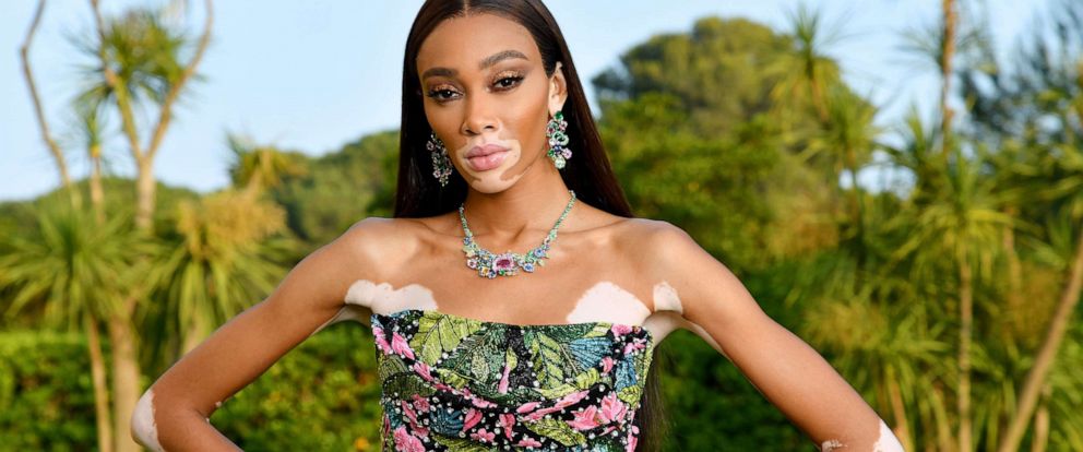 Winnie Harlow celebrates her first Vogue cover: 'Representation matters