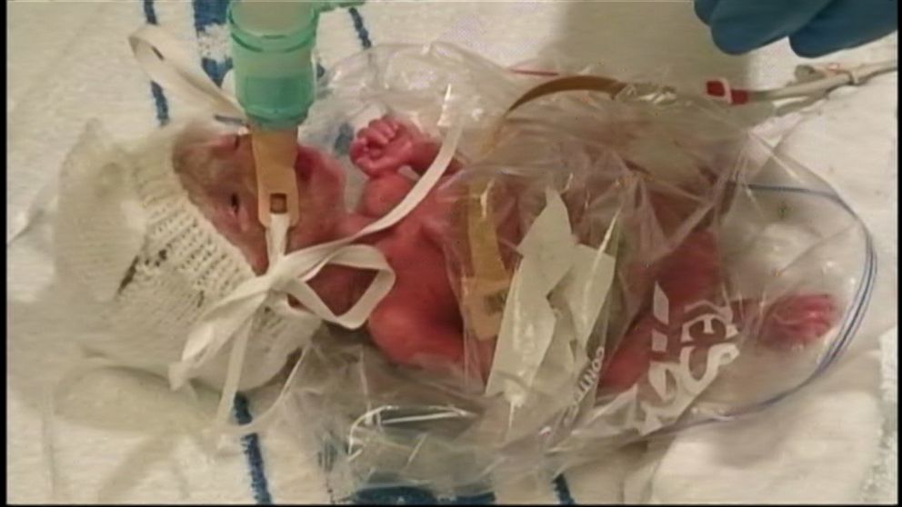 Sandwich Bag Helps Save Premature Baby's Life