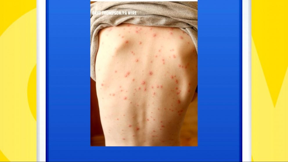 Researchers Use Google to Find Chickenpox Seasons Video - ABC News