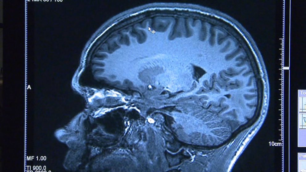 New Concussion Recommendations For Kids >> New Guidelines On Kids Concussions And What To Do Abc News New Concussion Recommendations For Kids >> New Guidelines On Kids Concussions And What To Do Abc News