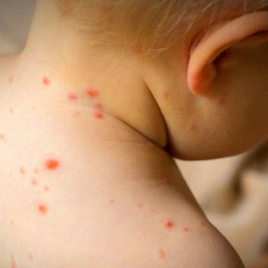 VIDEO: Measles outbreak sets 20-year record