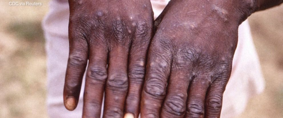 1st monkeypox case in US this year reported in Massachusetts - ABC News