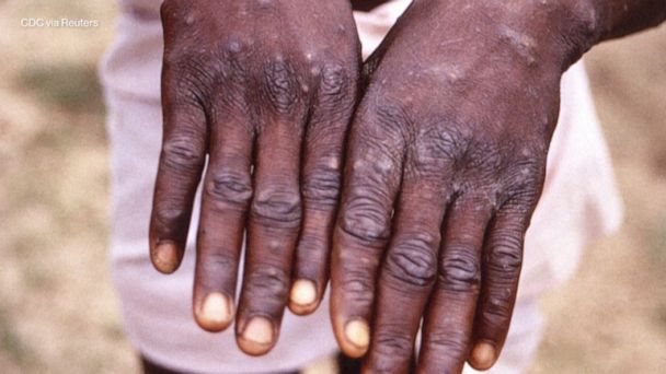 What to know about monkeypox
