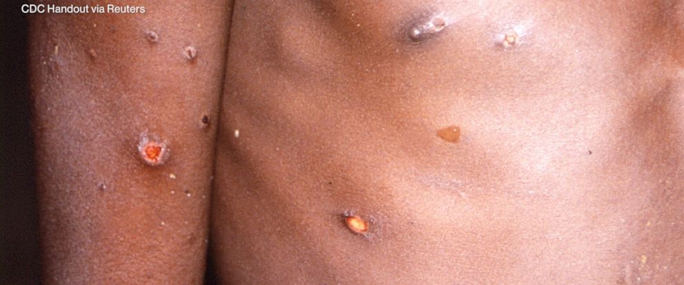 Can monkeypox cause keloid scars?