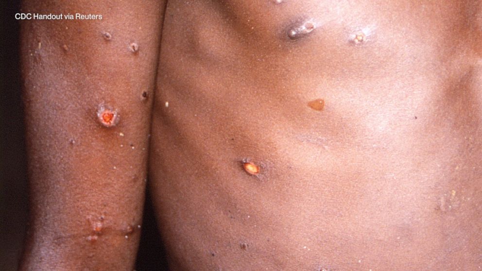 What's monkeypox?' Woman with 'insane rash' turned away for testing