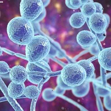 The CDC says a person can contract fungal meningitis after inhaling or ingesting microscopic spores from various fungi. 