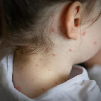 VIDEO: Measles death in US ‘a preventable tragedy’: Doctor