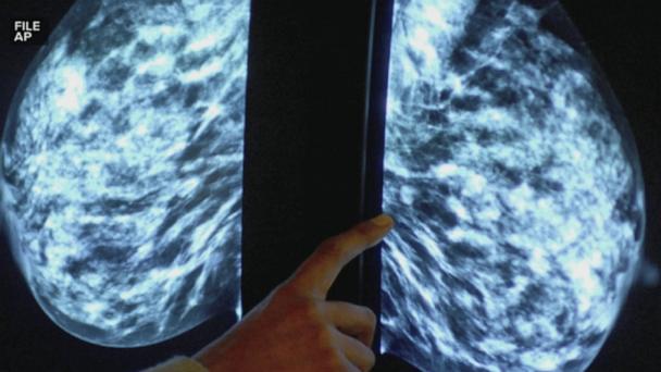 Early-onset cancer rising in younger Americans