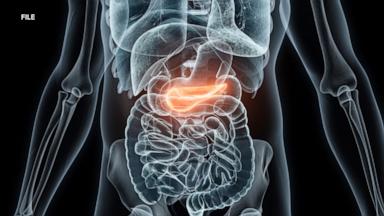 VIDEO: How a new drug could lengthen lives of pancreatic cancer patients