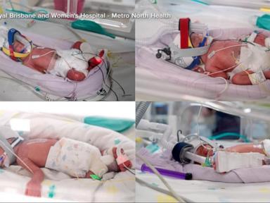 WATCH:  Woman gives birth to rare identical quadruplets