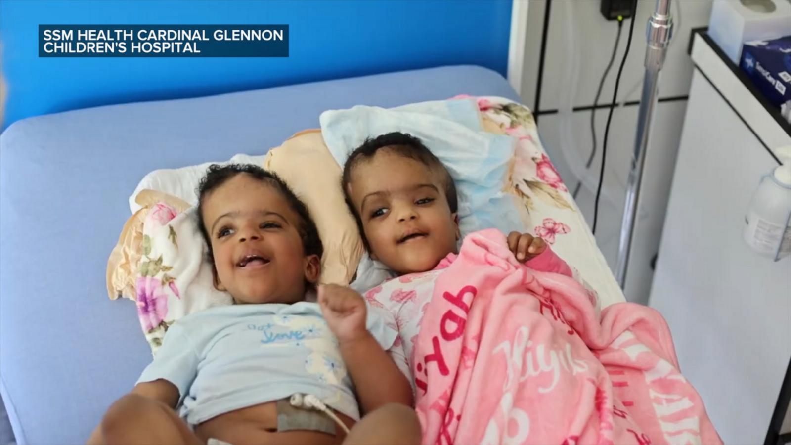 WATCH:  Conjoined twins begin new chapter after successful separation