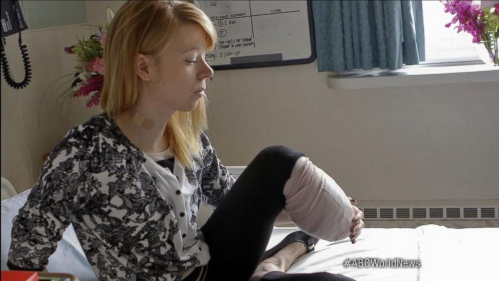PHOTO: Adrianne Haslet-Davis spent a year doing physical therapy after losing part of her leg in the Boston bombings attack, April 15, 2013.