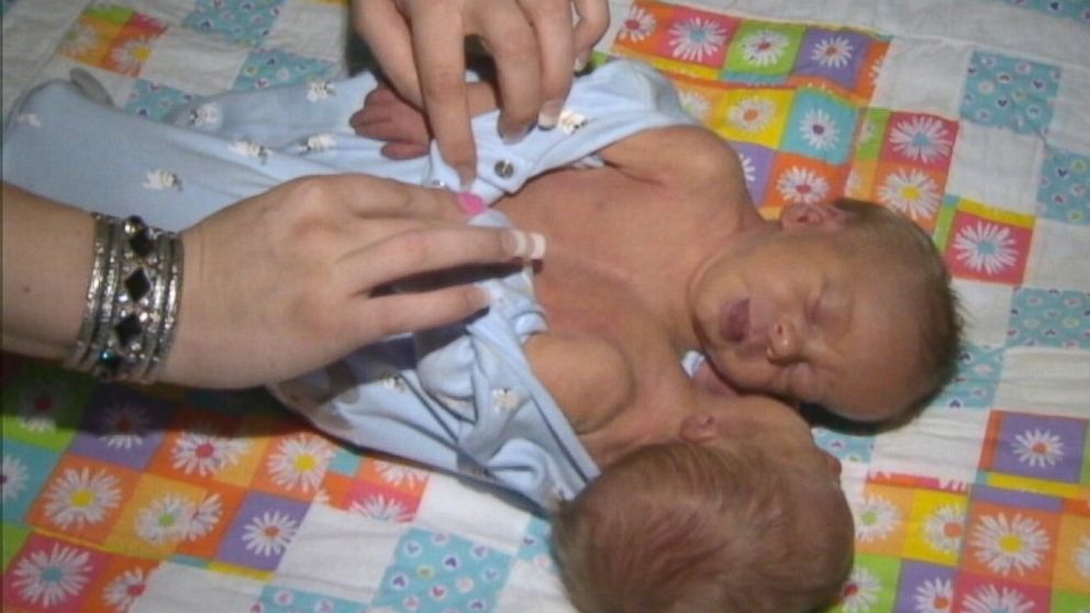 PHOTO: Conjoined twins, Andrew and Garrett Stancombe, were born last week in a Pennsylvania hospital. Doctors say it is too risky to separate them.