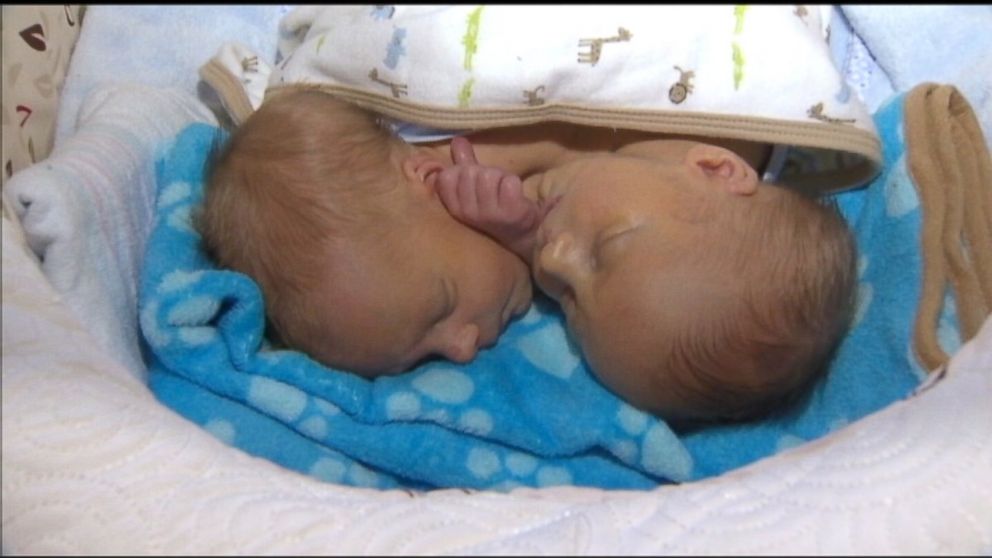 PHOTO: The Stancombe twins had a less than 25 percent chance of surviving separation surgery.