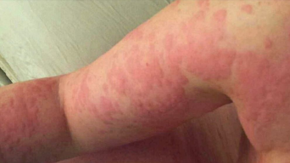 Florida Woman Allergic To Own Sweat Tears Details Her Ordeal With Rare 