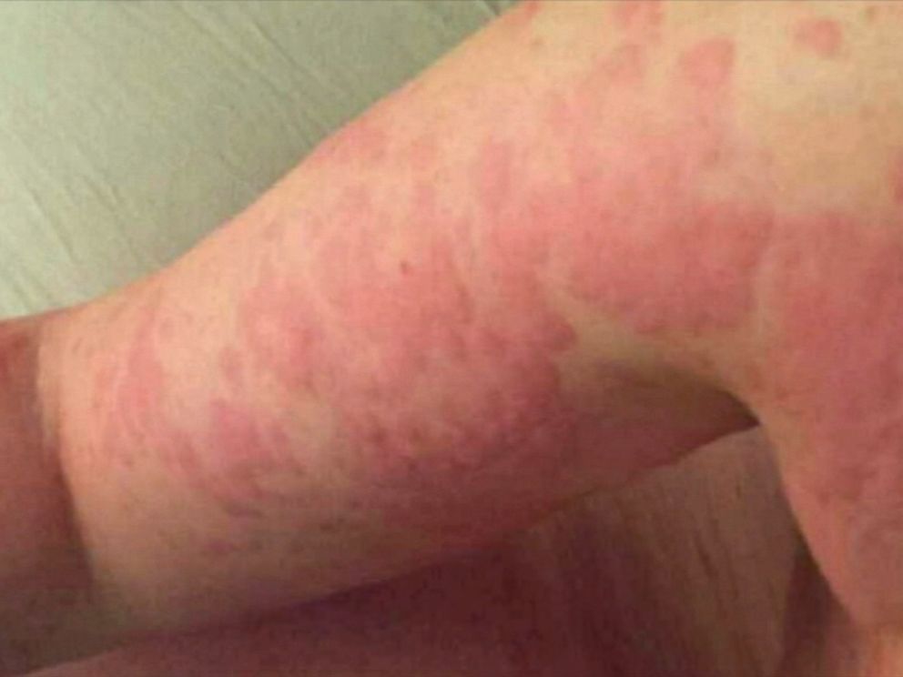 Cholinergic Urticaria