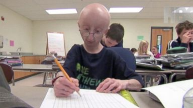 Sam Berns Boy With Aging Disease Progeria Dies At 17 Abc News