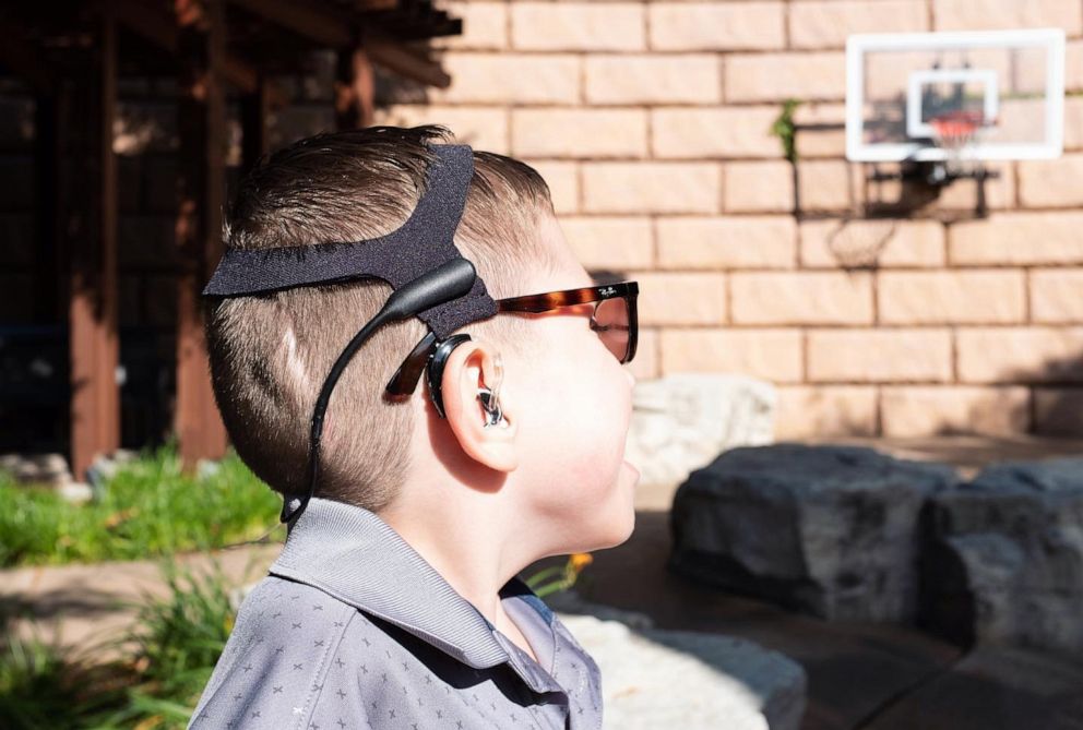 Children's hospital creates custom glasses system for child with ear  deformity - ABC News