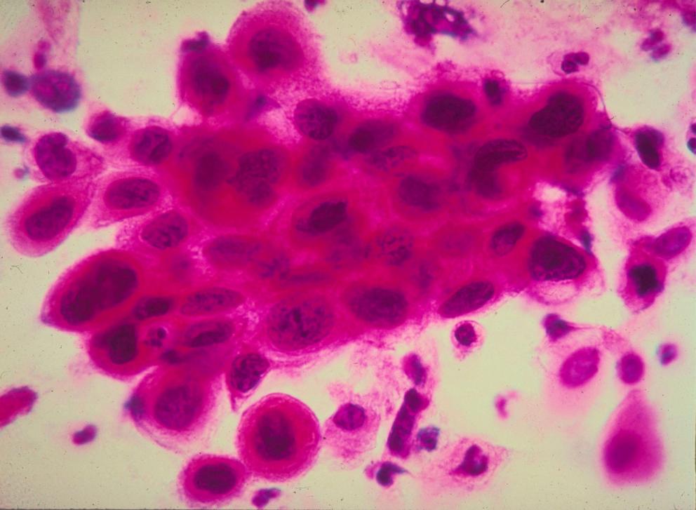 PHOTO: Close up of cancer cells in the cervix. 