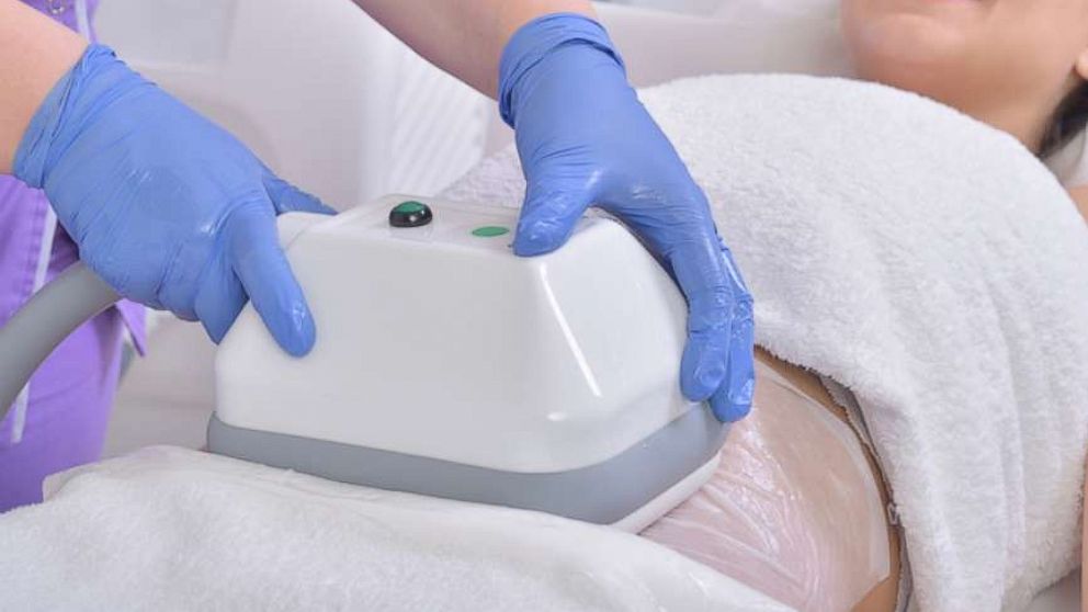 A woman undergoes cryolipolysis in this undated stock photo.