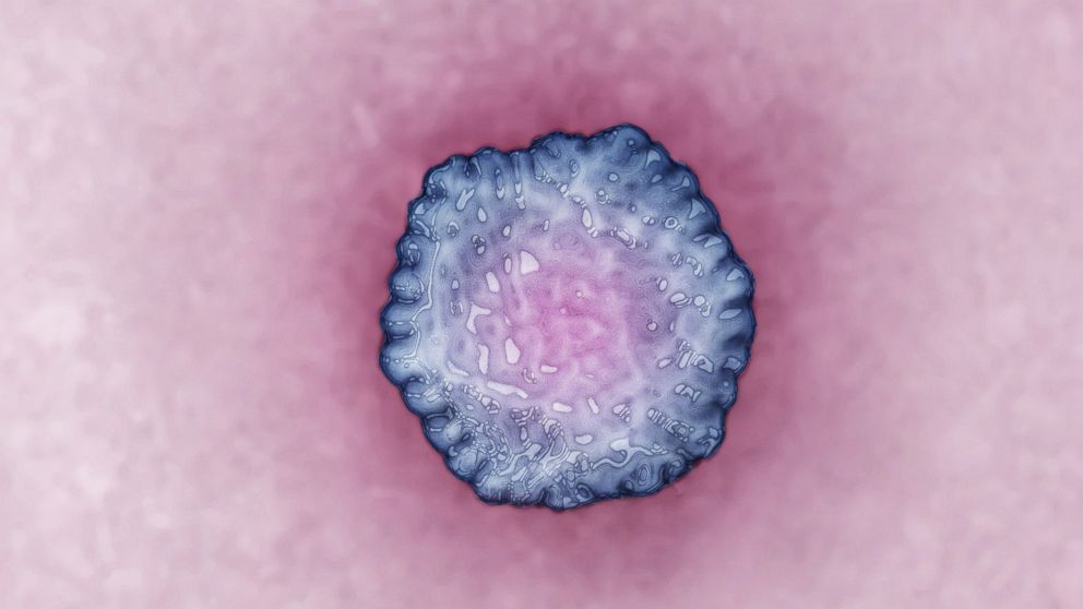 PHOTO: Hepatitis A virus (HAV) causes an often asymptomatic hepatitis (in 90% of cases) and is almost always benign. It is transmitted enterally through contaminated water and food.