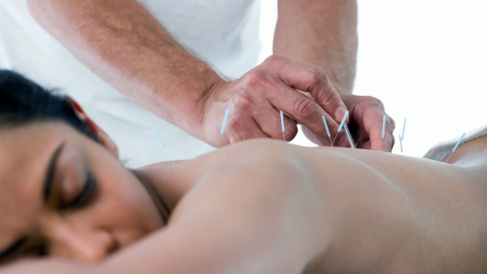 PHOTO: More than 14 million Americans have tried acupuncture for pain relief.