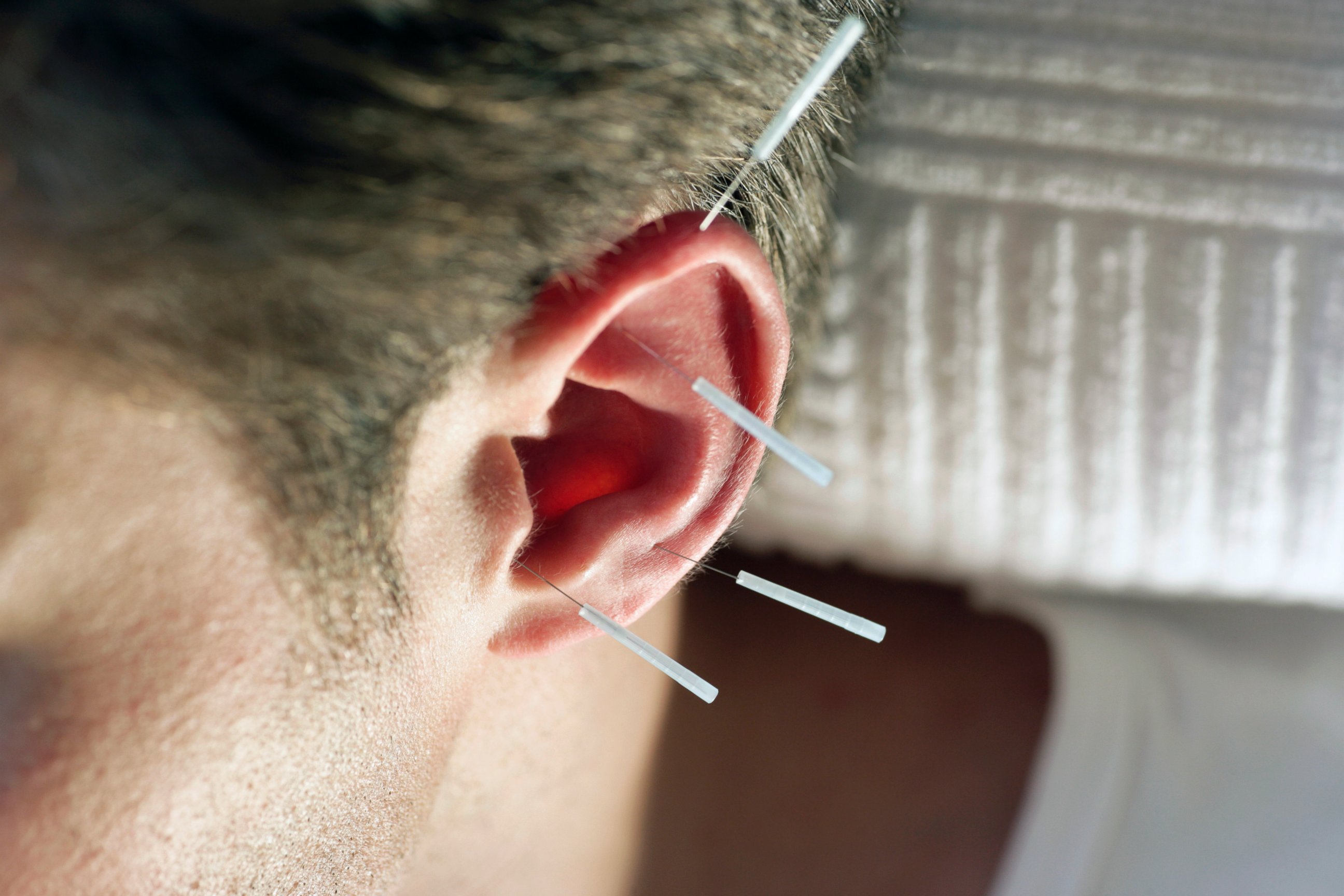 PHOTO: The military uses auricular acupuncture to treat pain on and off the battlefield.