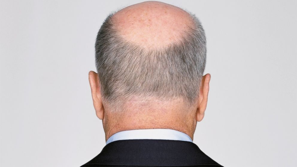 PHOTO:  By the age of 50 approximately 85 percent of men have significantly thinning hair.