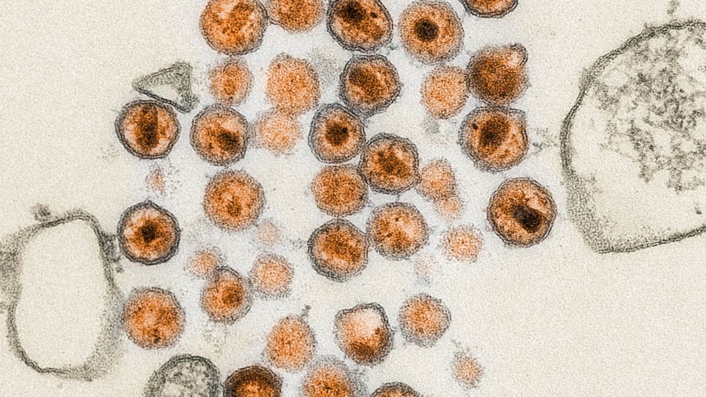 PHOTO: Electron micrograph of the HIV virus.