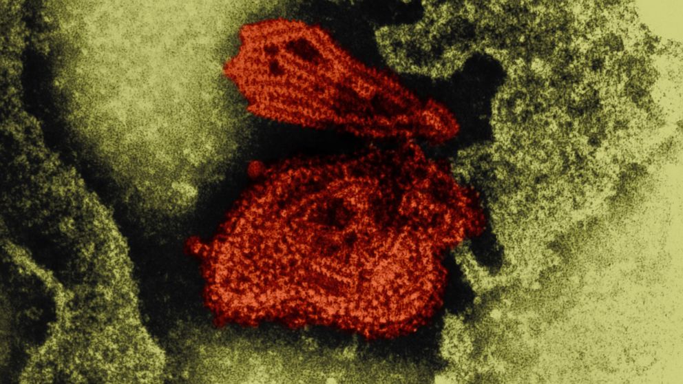 PHOTO: Mumps virus is seen in this color enhanced, negative stained Transmission Electron Micrograph.