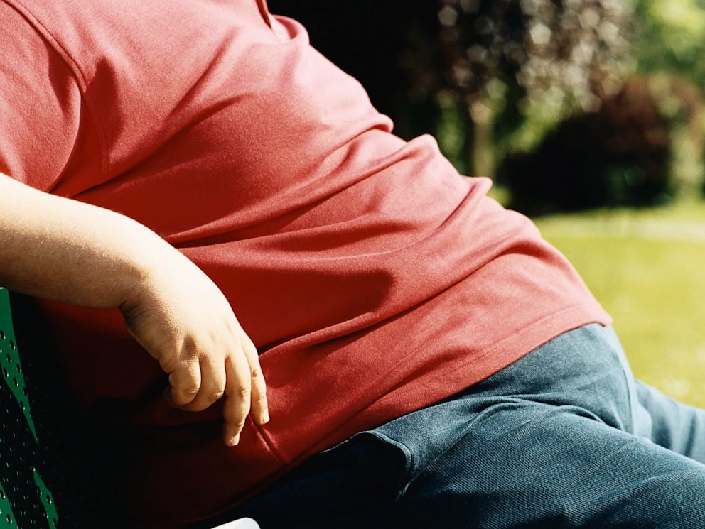 PHOTO: obesity
