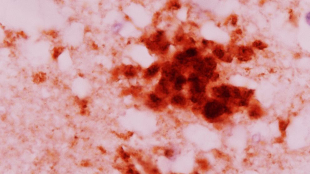 An observation of human brain tissue is pictured, the brown spots are the concentrations of prions, which characterize a variant of Creutzfeldt-Jakob disease.