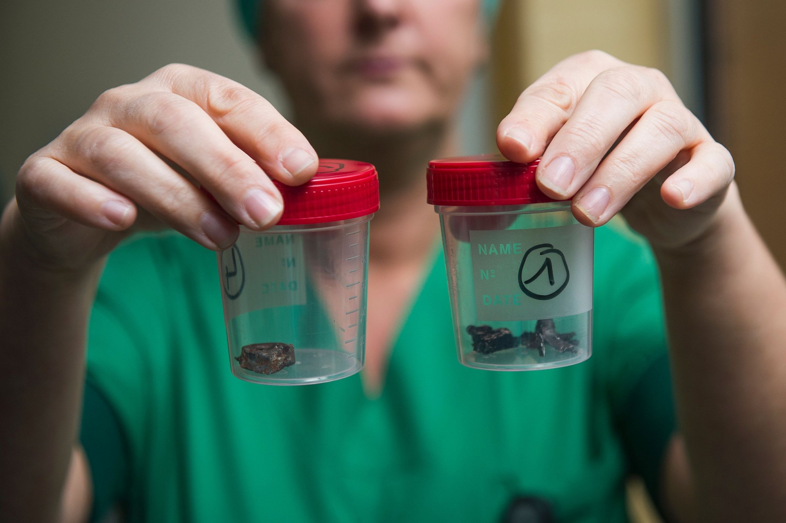PHOTO: A nurse of the 'Campus Gasthuisberg UZ' hospital in Leuven, Belgium, shows fragments of iron shrapnel from a nail bomb, March 24, 2016.