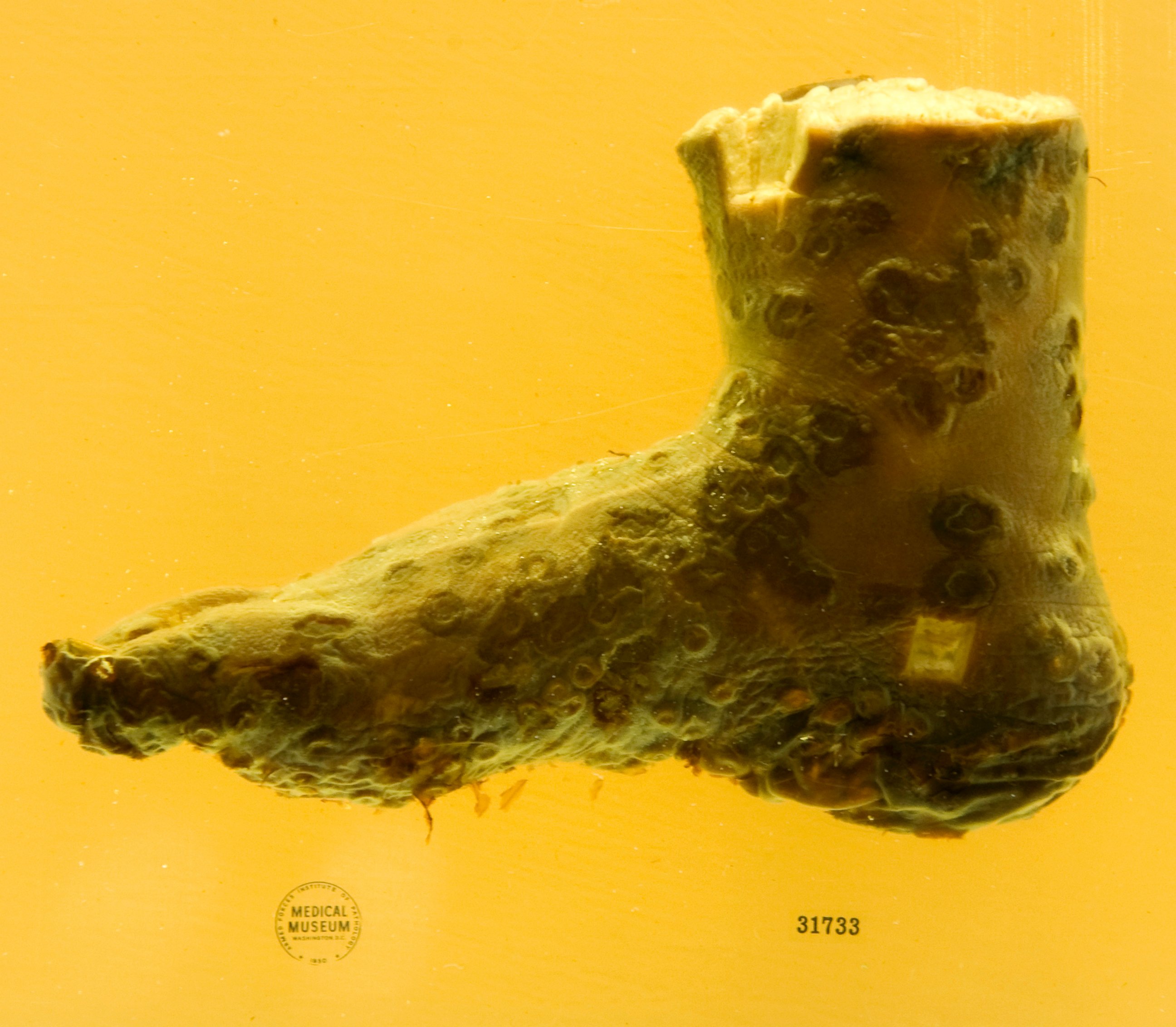 PHOTO: A preserved human foot with smallpox on exhibit at the new location of The National Museum of Health and Science in Silver Spring, MD, May 16, 2012.