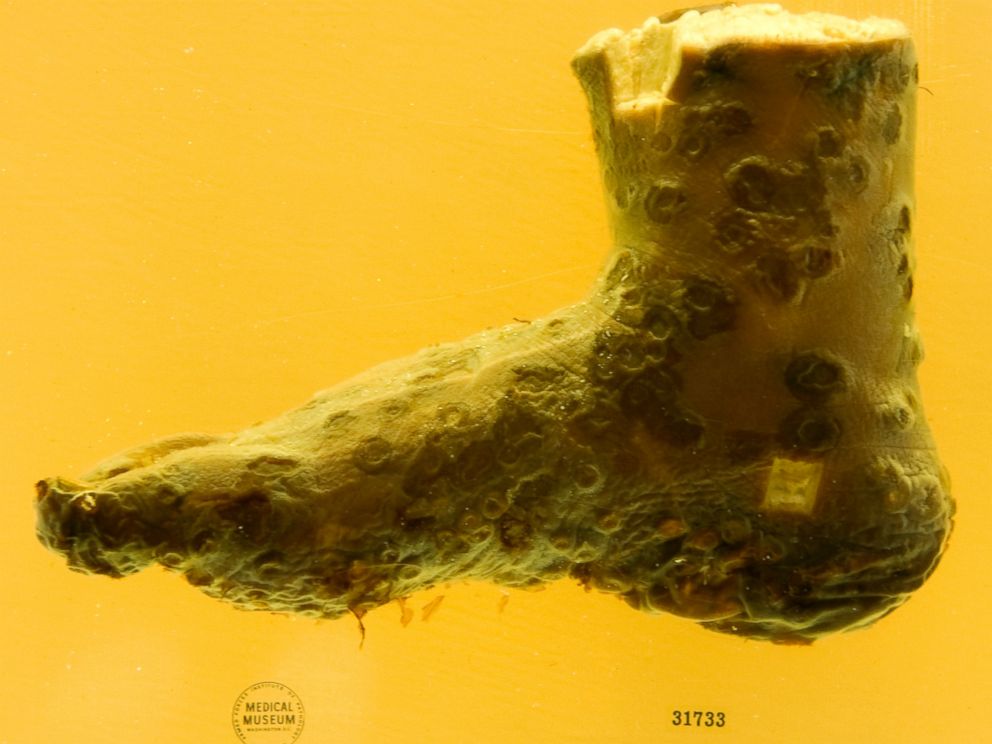 PHOTO: A preserved human foot with smallpox on exhibit at the new location of The National Museum of Health and Science in Silver Spring, MD, May 16, 2012.