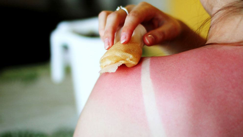 Here are some tips for treating your next sunburn.