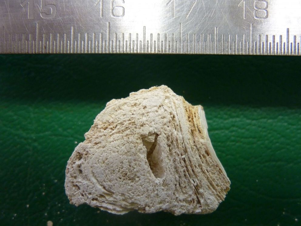 PHOTO: A cross section (measured in centimeters) of a calcified nodule found in a skeleton dating to Byzantine Troy, sometime around the 13th century.