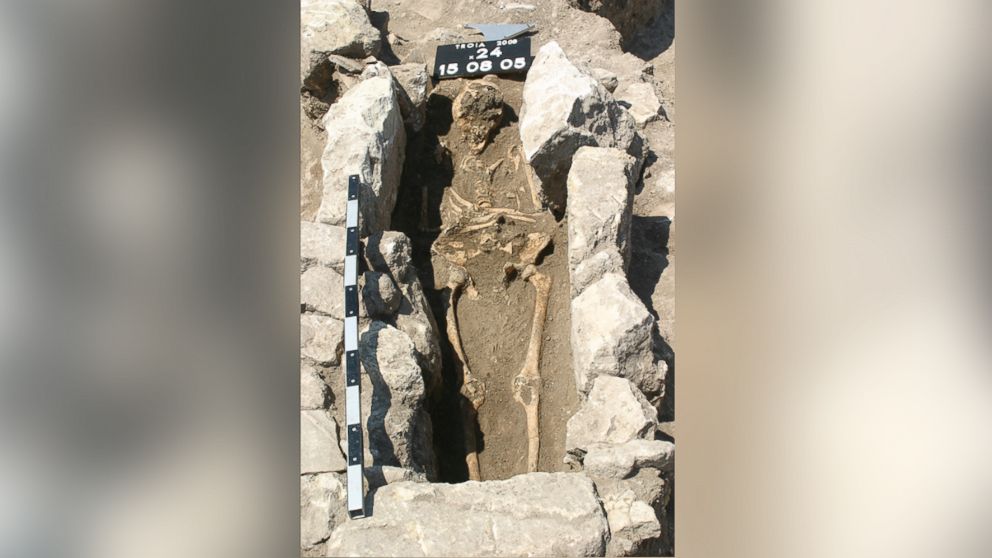 The skeleton of a woman who died 800 years ago on the outskirts of the ancient city of Troy in modern Turkey has yielded the first record of maternal sepsis in the fossil record. DNA locked inside the calcified nodules, found at the base of the chest and extracted by researchers, yielded the complete genomes of the pathogenic bacteria likely responsible for the woman's death.