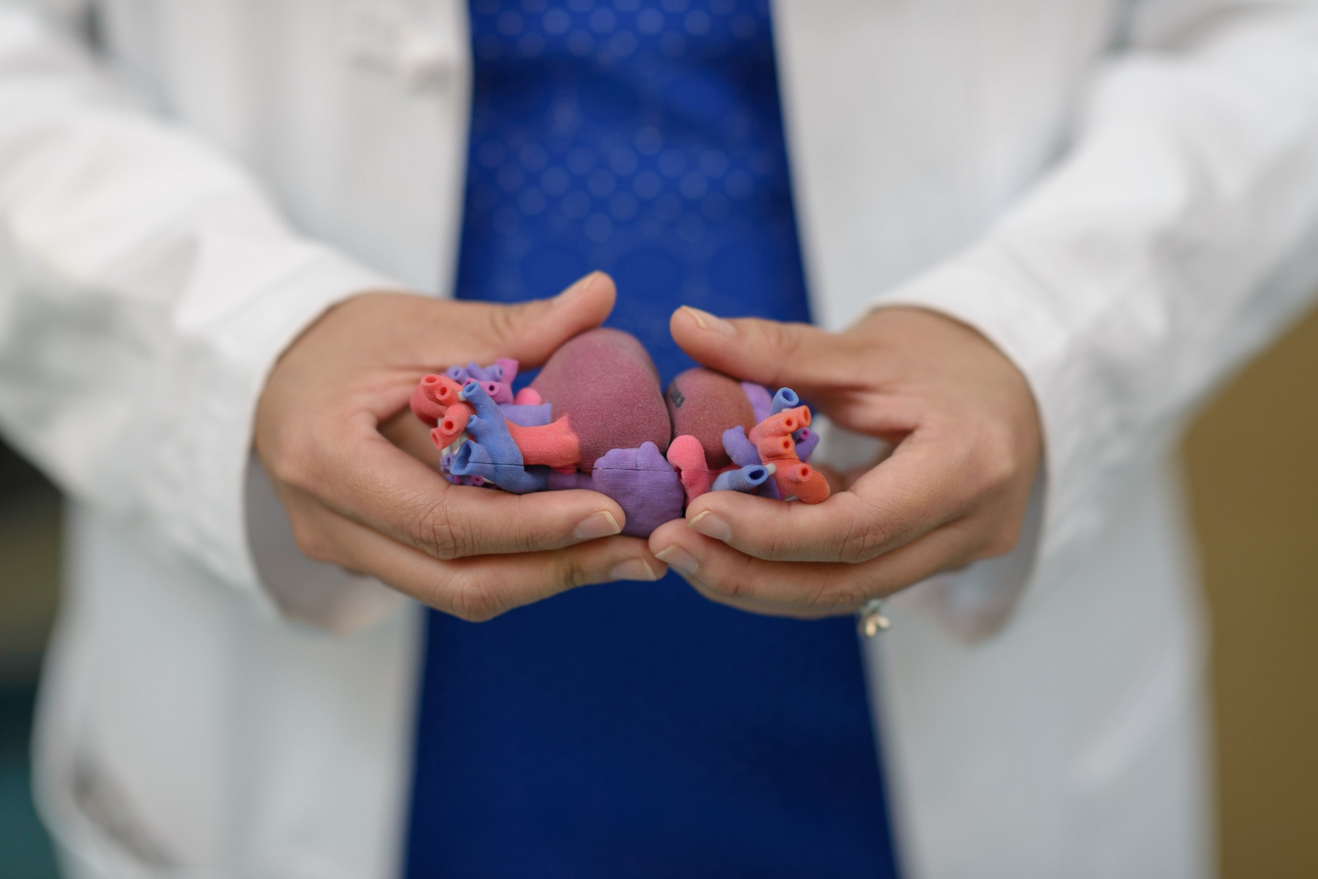 PHOTO: Doctors at the University of Florida Shands Children's Hospital in Gainesville, Florida, created a life-sized model of the conjoined twins' hearts using 3-D printing. 