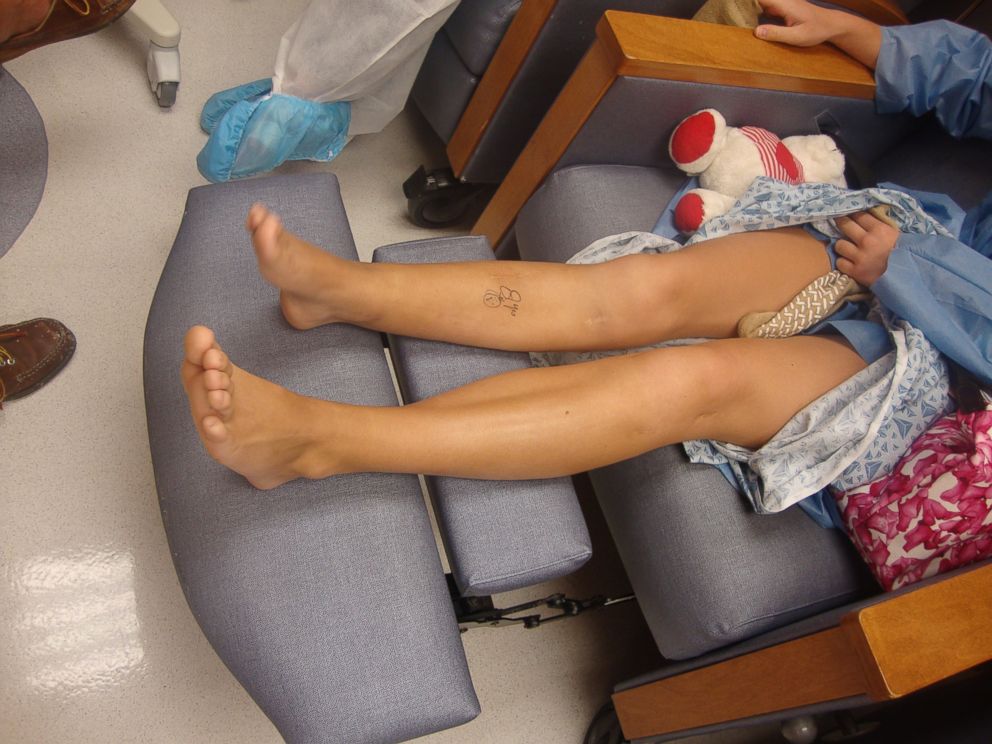 PHOTO: As a result of damage to her growth plate, one of Robinson's legs was 2.5 inches shorter than the other.