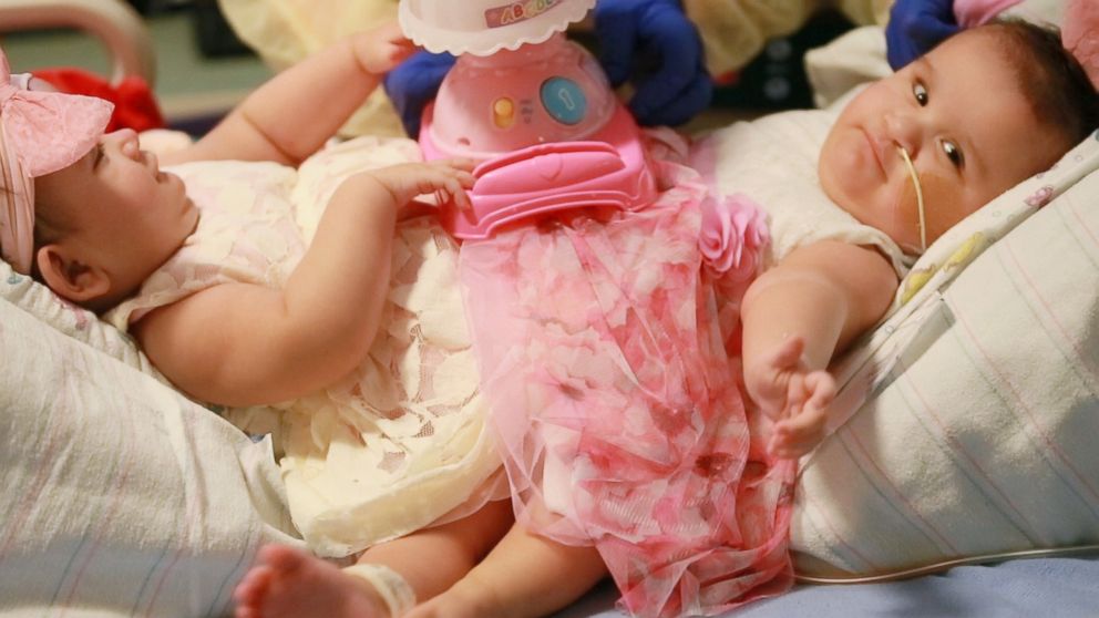Doctors are working to separate a pair of conjoined twin girls, who are fused at the waist. 