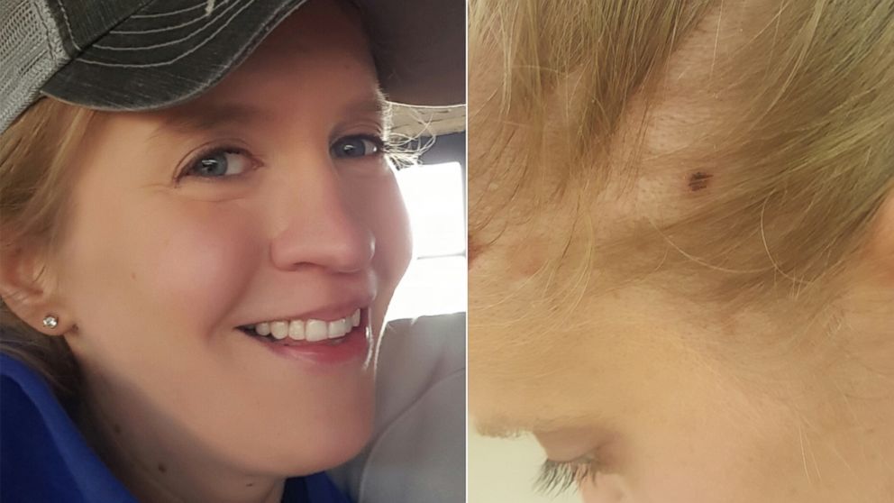 PHOTO: Erica Dingler shown here has had multiple skin cancer growths removed. Doctors removed the mole above as a precaution earlier this month. 