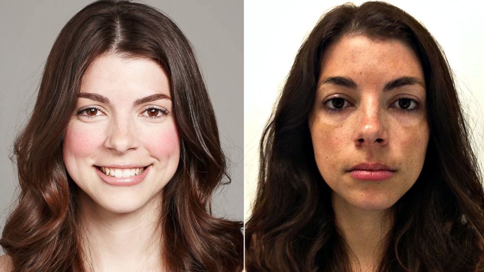 Undated photos of Kaitlin Menza, 28, and two years later after a sunburn left her with permanent dark patches on her cheeks and forehead that are still visible. 