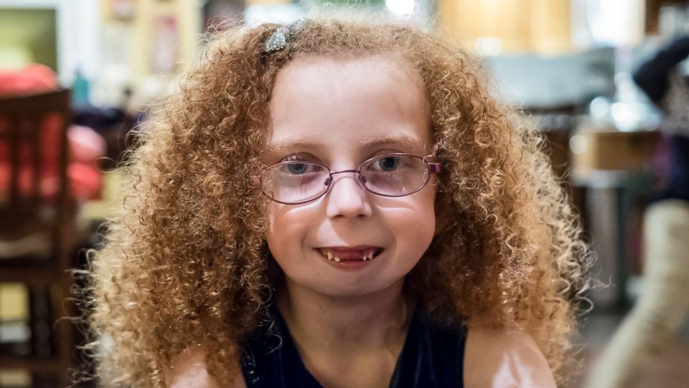 Alexis Melton was born with a one in a million condition that left her with almost no jaw. 